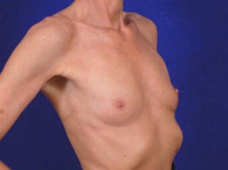 Breast Augmentation by Dr. Wilder Gallery - Patient 55455374 - Image 3
