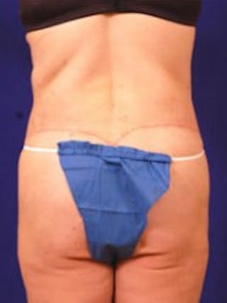 After Weight Loss Surgery by Dr. Wilder Before & After Gallery - Patient 55455373 - Image 6
