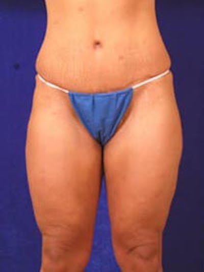 Lower Body Lift by Dr. Wilder Before & After Gallery - Patient 55455375 - Image 1