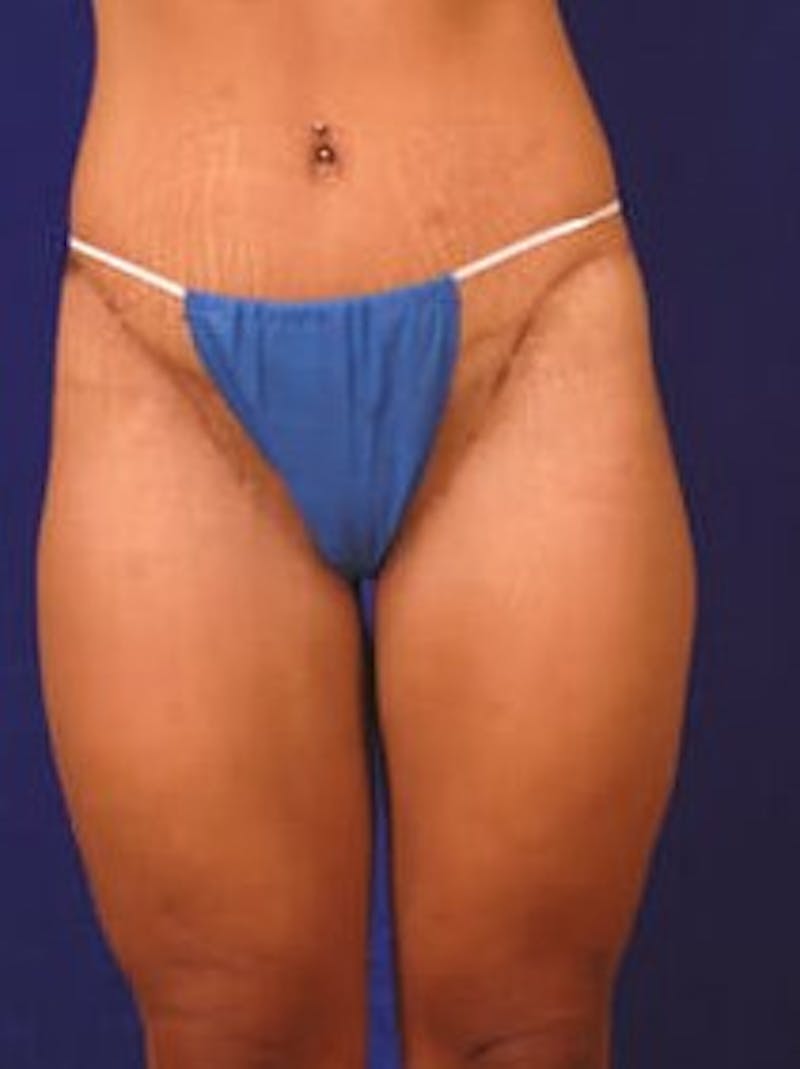 After Weight Loss Surgery by Dr. Wilder Before & After Gallery - Patient 55455377 - Image 2
