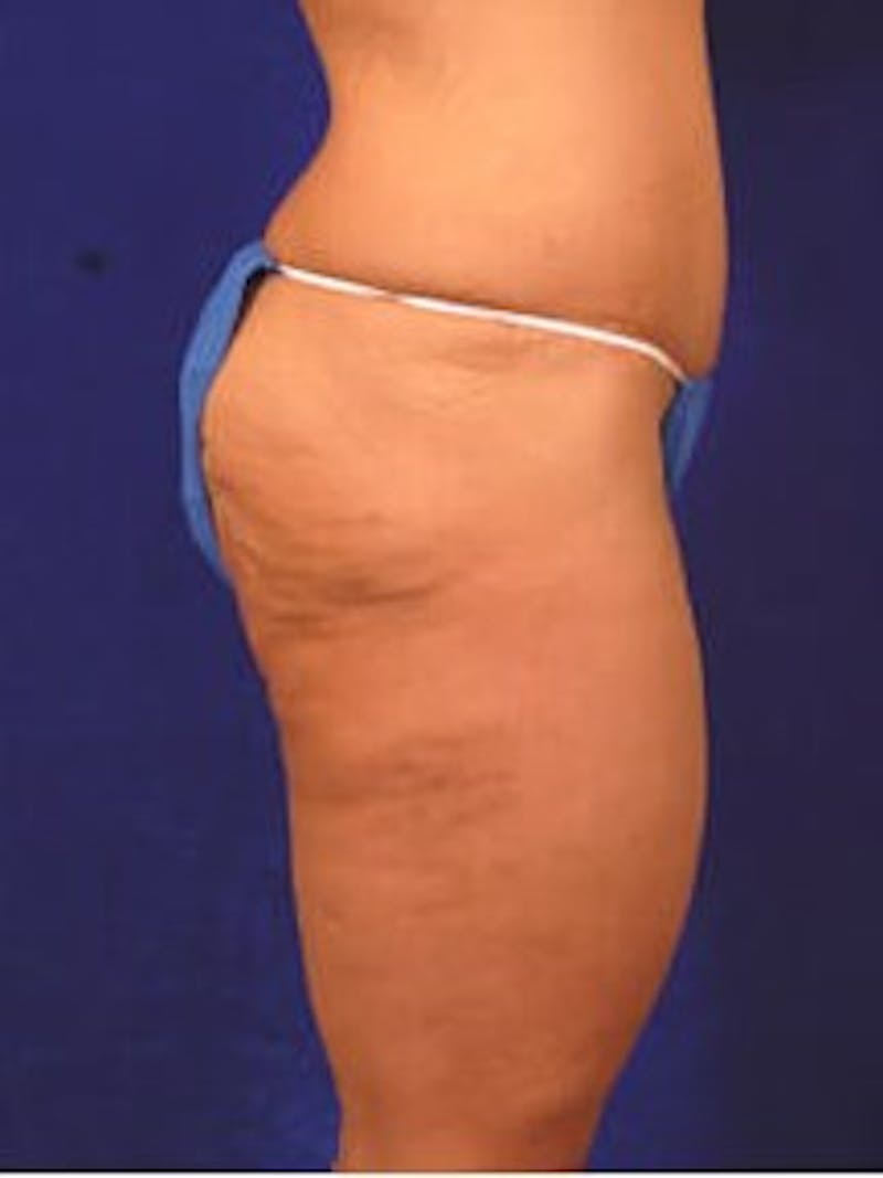 After Weight Loss Surgery by Dr. Wilder Gallery - Patient 55455377 - Image 3