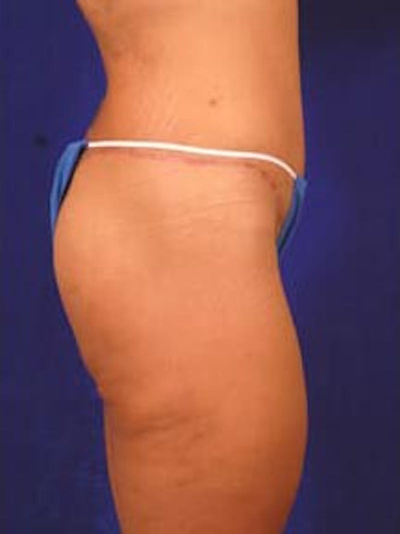 After Weight Loss Surgery by Dr. Wilder Before & After Gallery - Patient 55455377 - Image 4