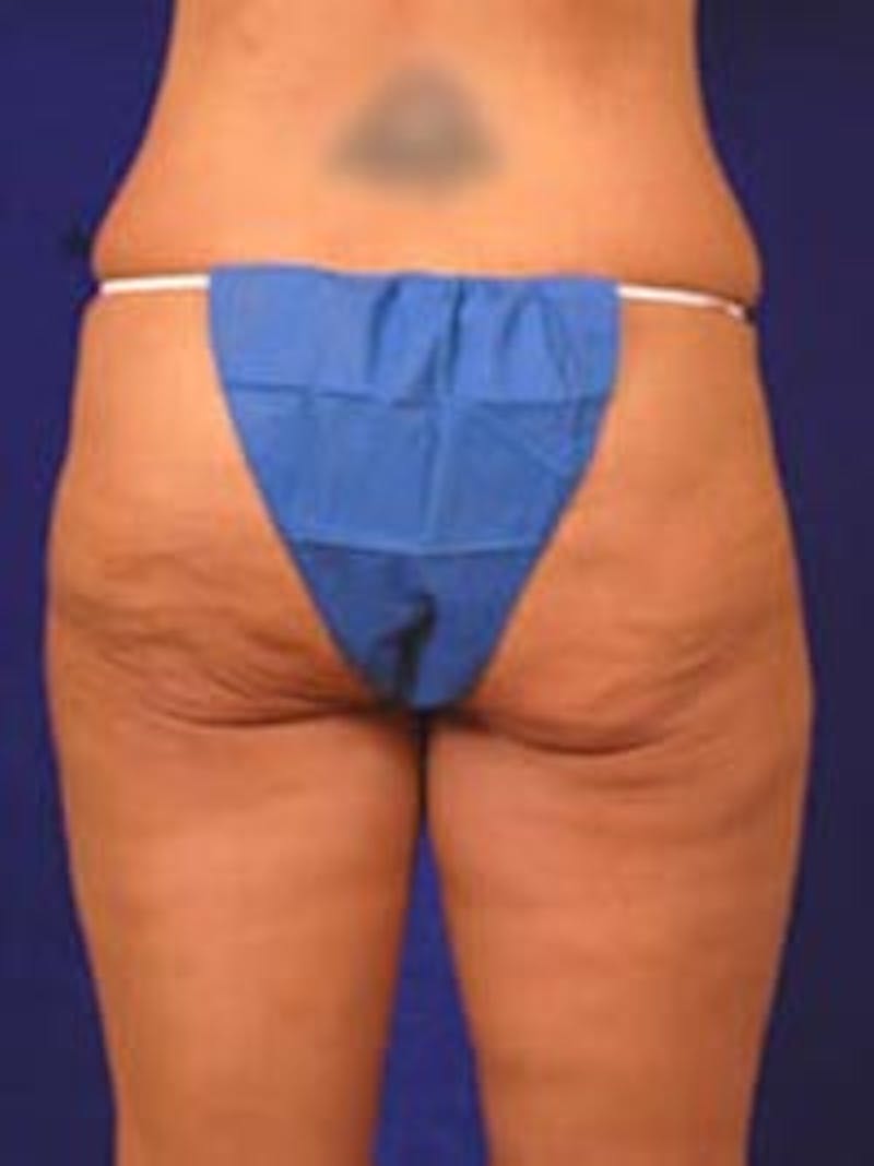 After Weight Loss Surgery by Dr. Wilder Before & After Gallery - Patient 55455377 - Image 5