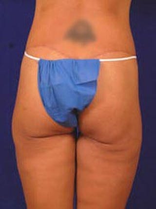 Lower Body Lift by Dr. Wilder Before & After Gallery - Patient 55455375 - Image 6