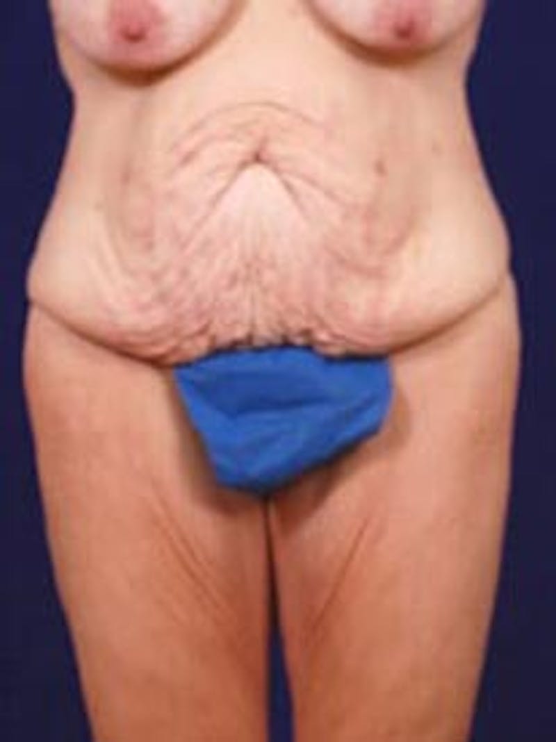 Thigh Lift by Dr. Wilder Before & After Gallery - Patient 55455379 - Image 1