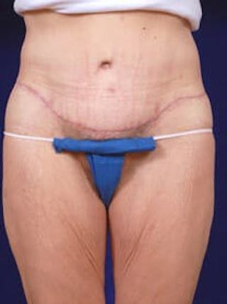 Thigh Lift by Dr. Wilder Before & After Gallery - Patient 55455379 - Image 2