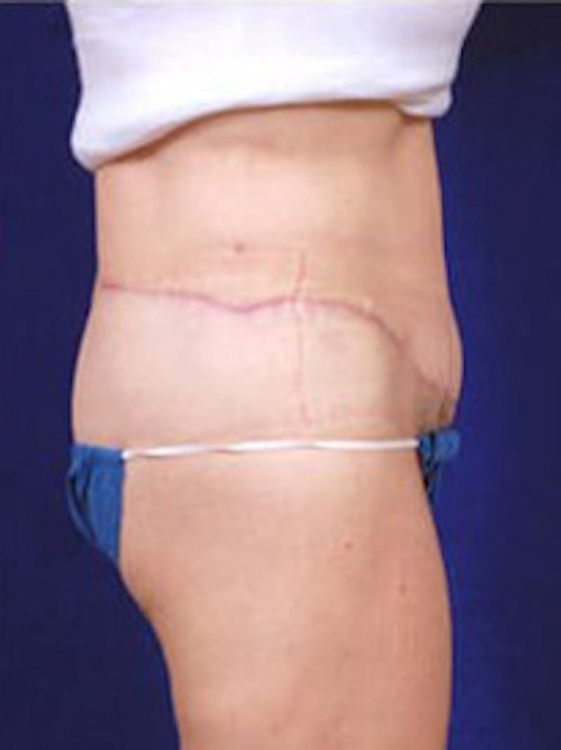 Thigh Lift by Dr. Wilder Before & After Gallery - Patient 55455379 - Image 4