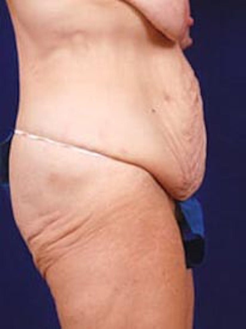 After Weight Loss Surgery by Dr. Wilder Before & After Gallery - Patient 55455380 - Image 3
