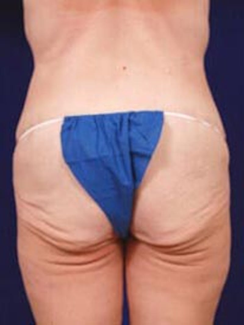 Thigh Lift by Dr. Wilder Before & After Gallery - Patient 55455379 - Image 5
