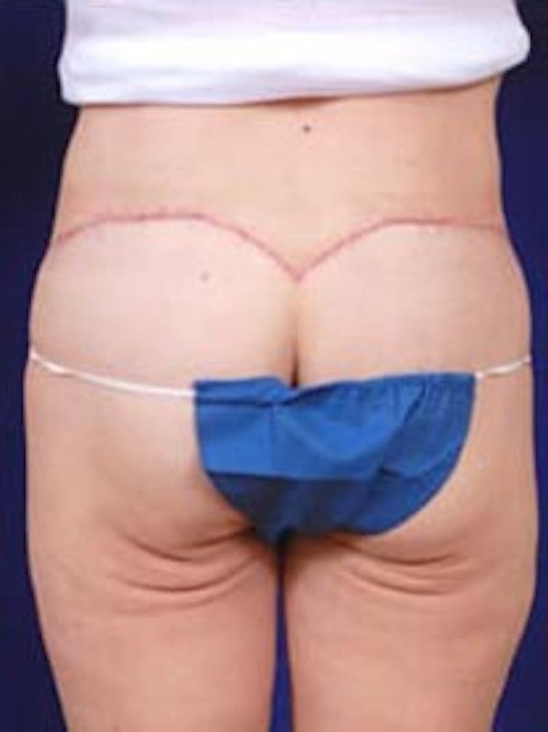 After Weight Loss Surgery by Dr. Wilder Before & After Gallery - Patient 55455380 - Image 6