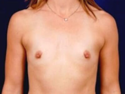 Breast Augmentation by Dr. Wilder Before & After Gallery - Patient 55455387 - Image 1