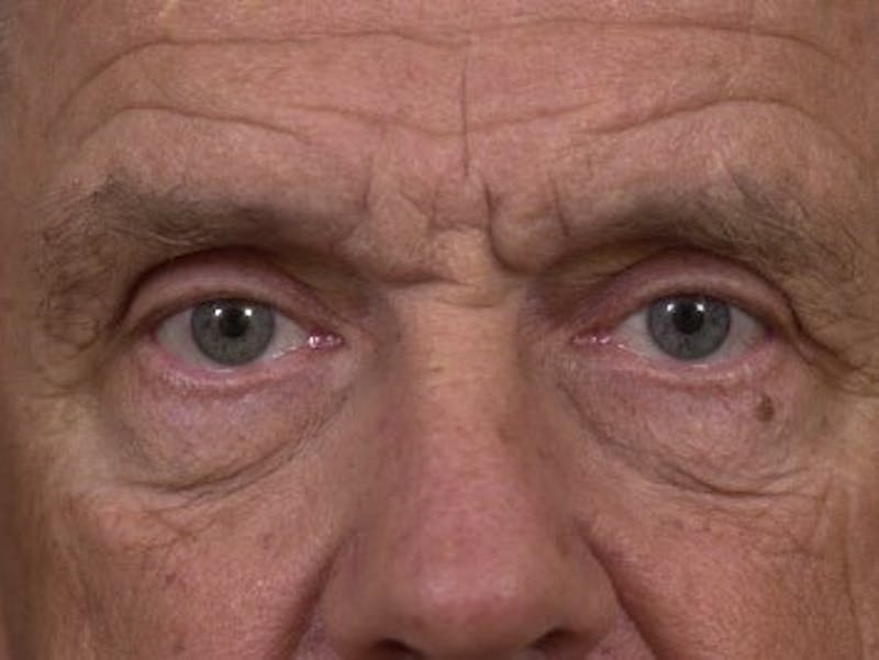 Eyelid Surgery by Dr. Wilder Before & After Gallery - Patient 55455386 - Image 2