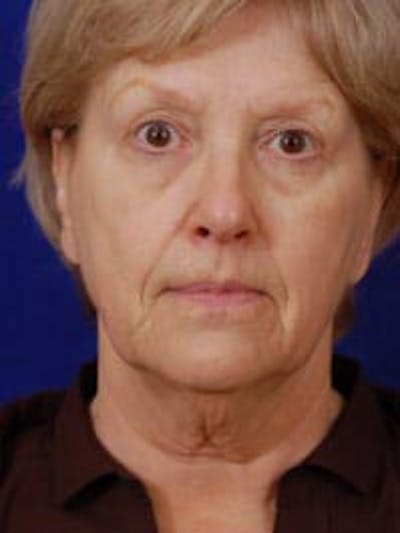 Facelift by Dr. Wilder Before & After Gallery - Patient 55455389 - Image 1