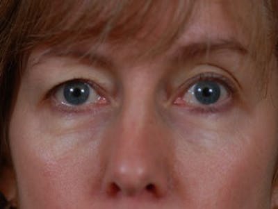 Eyelid Surgery by Dr. Wilder Before & After Gallery - Patient 55455388 - Image 1