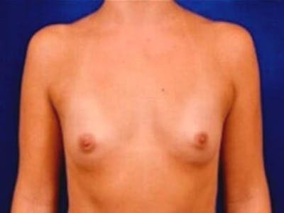 Breast Augmentation by Dr. Wilder Before & After Gallery - Patient 55455390 - Image 1