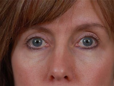 Eyelid Surgery by Dr. Wilder Before & After Gallery - Patient 55455388 - Image 2