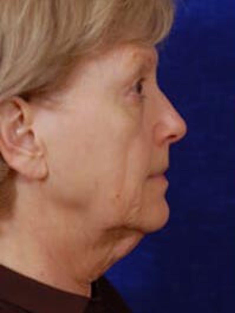 Facelift by Dr. Wilder Before & After Gallery - Patient 55455389 - Image 3
