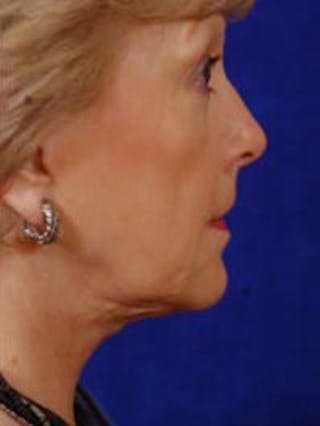 Facelift by Dr. Wilder Before & After Gallery - Patient 55455389 - Image 4