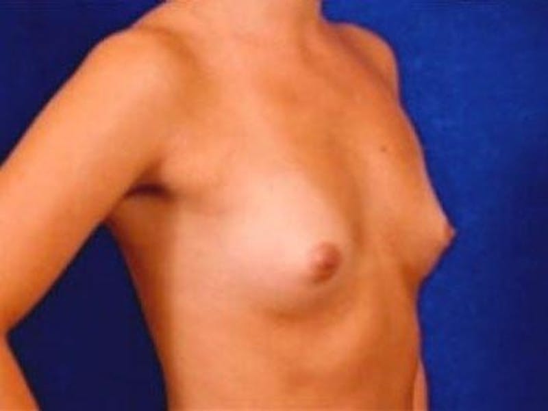 Breast Augmentation by Dr. Wilder Before & After Gallery - Patient 55455390 - Image 3