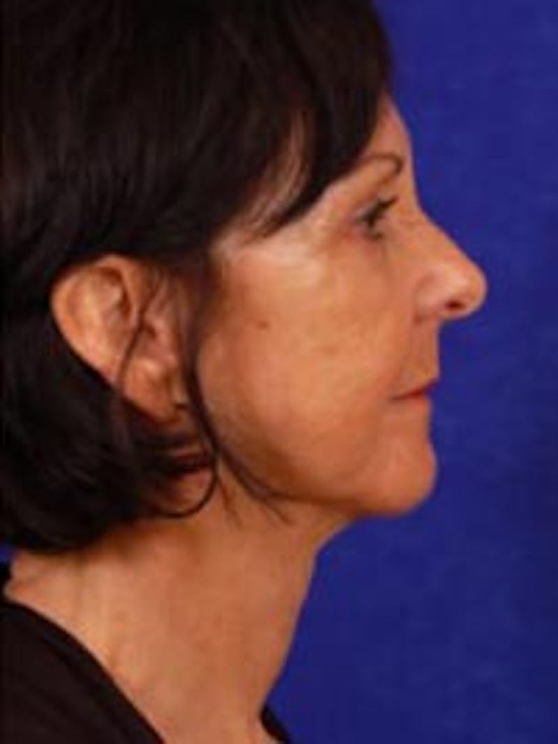 Eyelid Surgery by Dr. Wilder Gallery - Patient 55455393 - Image 4