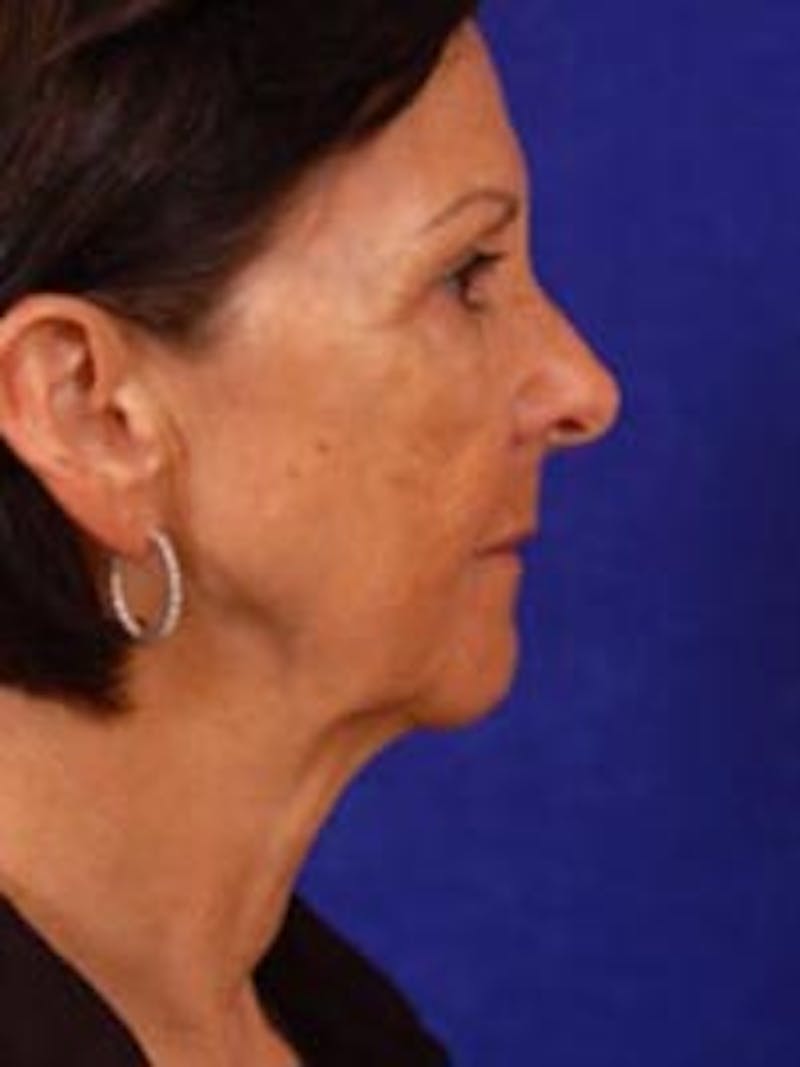 Facelift by Dr. Wilder Before & After Gallery - Patient 55455391 - Image 3