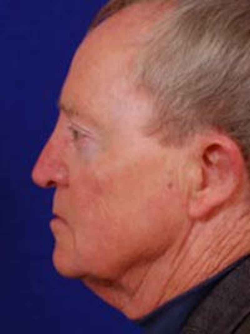 Facelift by Dr. Wilder Before & After Gallery - Patient 55455394 - Image 3