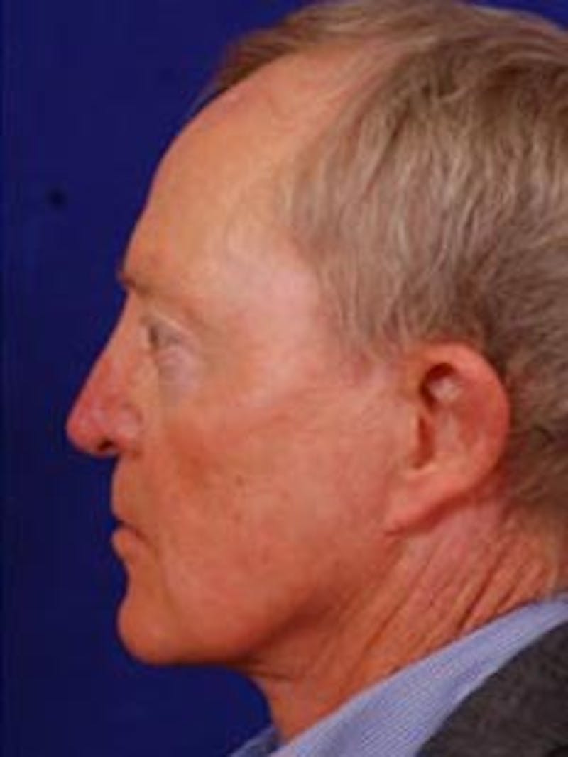 Facelift by Dr. Wilder Before & After Gallery - Patient 55455394 - Image 4