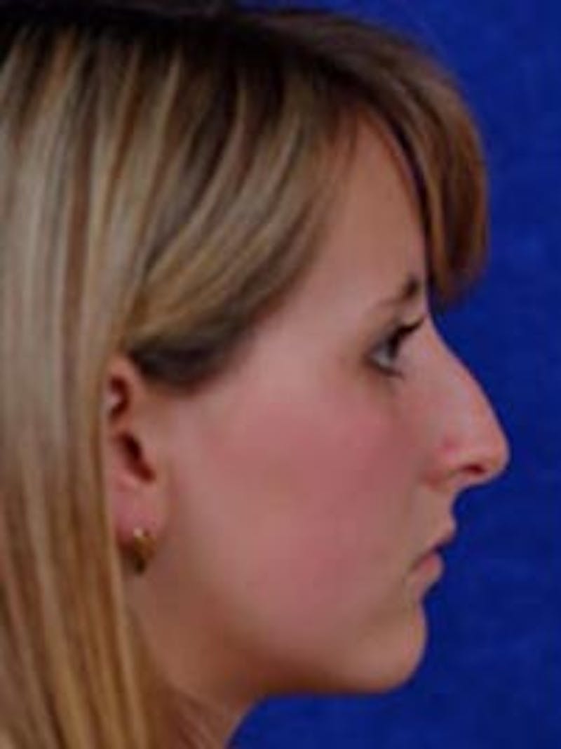 Rhinoplasty by Dr. Wilder Before & After Gallery - Patient 55455396 - Image 3