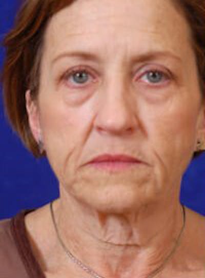 Facelift by Dr. Wilder Before & After Gallery - Patient 55455398 - Image 1