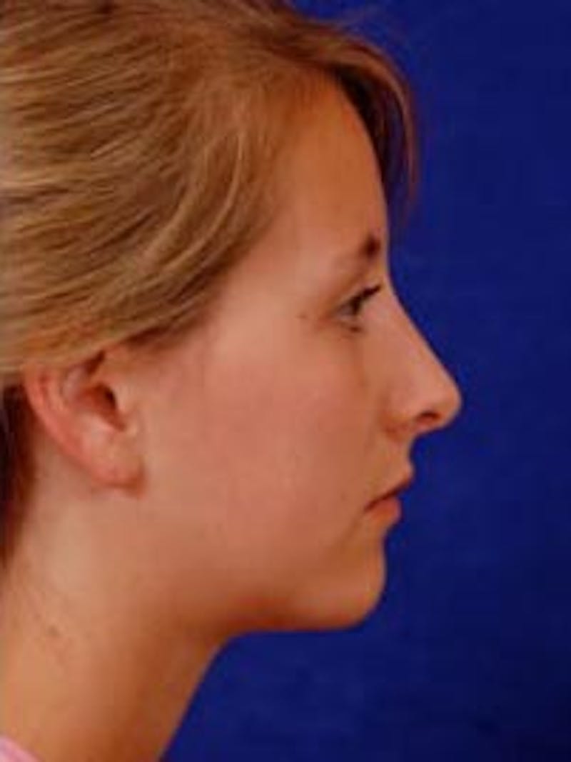 Rhinoplasty by Dr. Wilder Before & After Gallery - Patient 55455396 - Image 4
