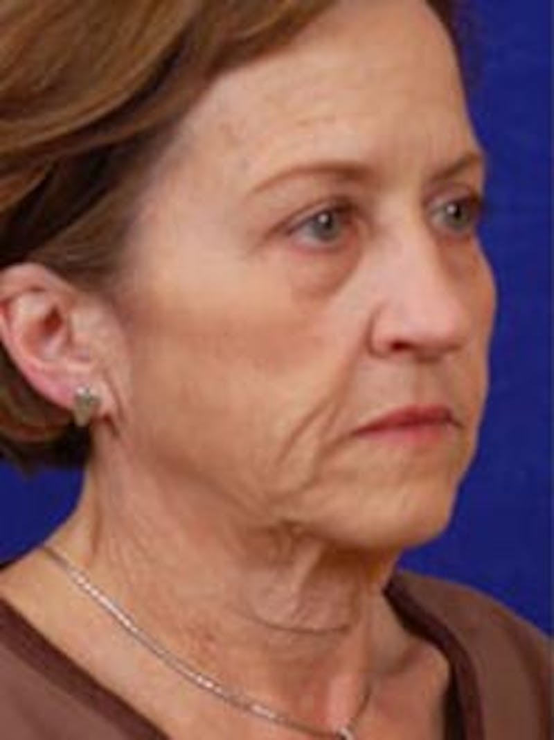 Facelift by Dr. Wilder Before & After Gallery - Patient 55455398 - Image 3