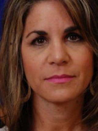 Rhinoplasty by Dr. Wilder Before & After Gallery - Patient 55455399 - Image 2