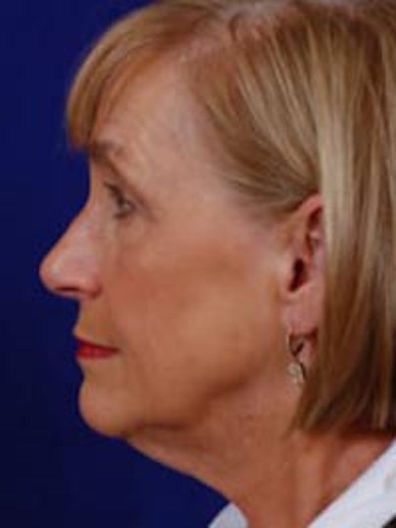 Facelift by Dr. Wilder Before & After Gallery - Patient 55455403 - Image 3