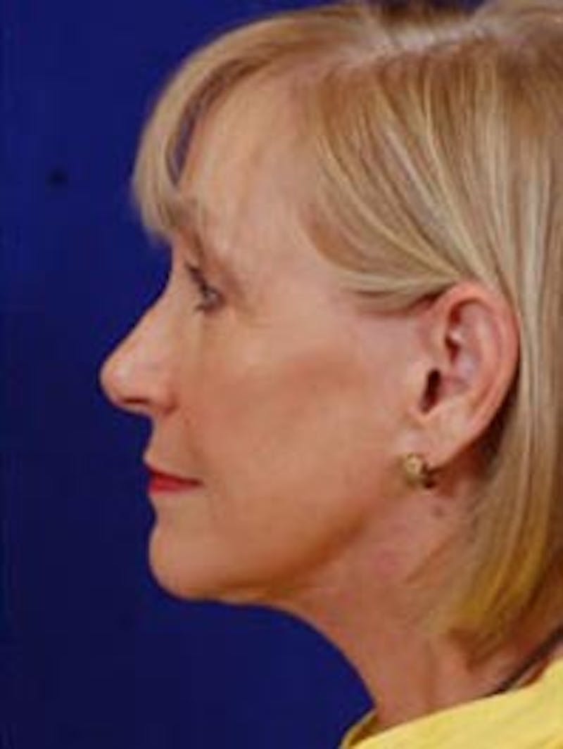 Facelift by Dr. Wilder Before & After Gallery - Patient 55455403 - Image 4
