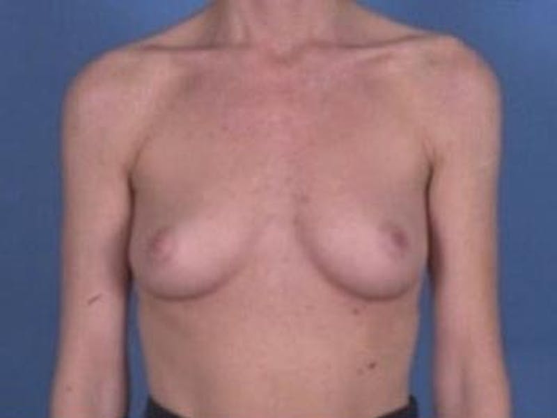 Breast Augmentation by Dr. Wilder Before & After Gallery - Patient 55455445 - Image 1