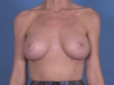 Breast Augmentation by Dr. Wilder Before & After Gallery - Patient 55455445 - Image 2