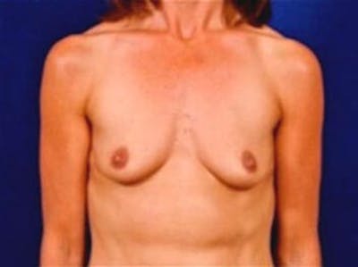 Breast Augmentation by Dr. Wilder Before & After Gallery - Patient 55455450 - Image 1