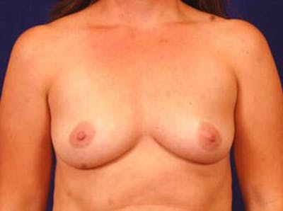 Breast Augmentation by Dr. Wilder Before & After Gallery - Patient 55455454 - Image 1