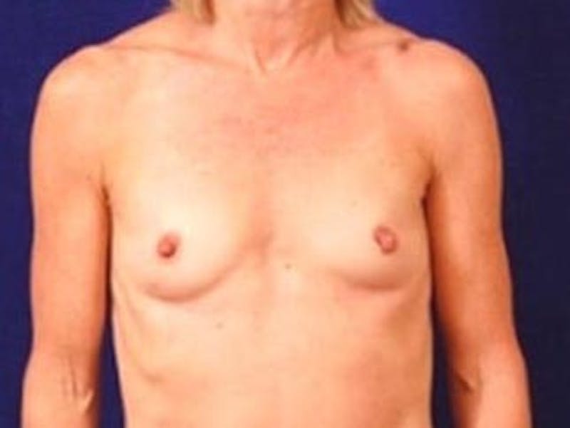 Breast Augmentation by Dr. Wilder Before & After Gallery - Patient 55455469 - Image 1