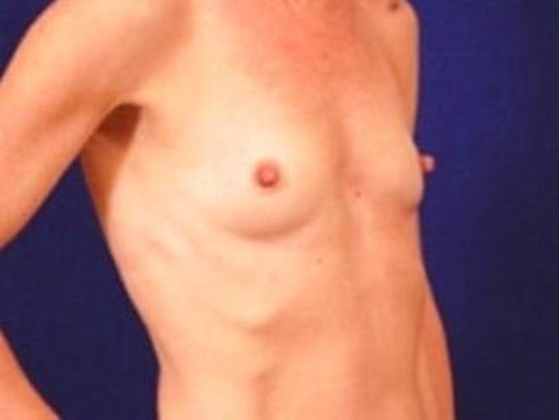 Breast Augmentation by Dr. Wilder Before & After Gallery - Patient 55455469 - Image 3