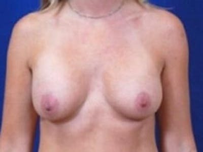 Breast Augmentation by Dr. Wilder Before & After Gallery - Patient 55455472 - Image 2
