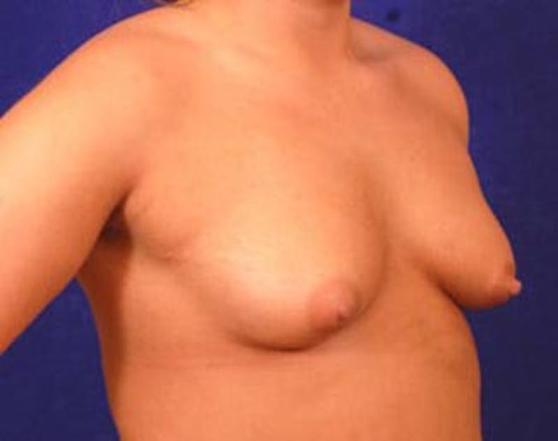 Breast Augmentation by Dr. Wilder Before & After Gallery - Patient 55455508 - Image 3