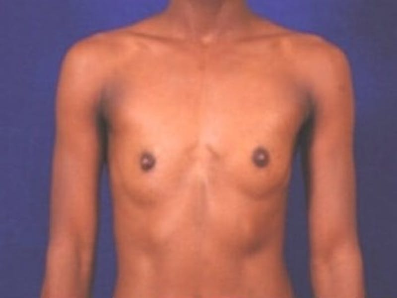 Breast Augmentation by Dr. Wilder Before & After Gallery - Patient 55455532 - Image 1