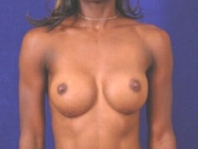 Breast Augmentation by Dr. Wilder Before & After Gallery - Patient 55455532 - Image 2