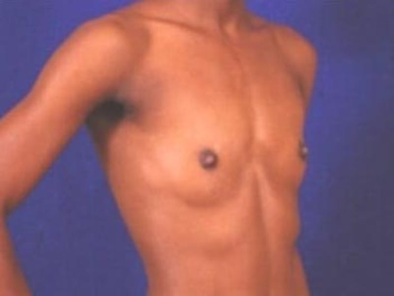 Breast Augmentation by Dr. Wilder Before & After Gallery - Patient 55455532 - Image 3