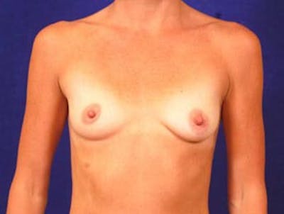Breast Augmentation by Dr. Wilder Before & After Gallery - Patient 55455534 - Image 1