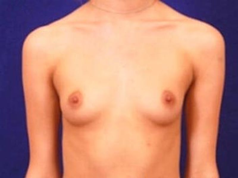 Breast Augmentation by Dr. Wilder Gallery - Patient 55455544 - Image 1