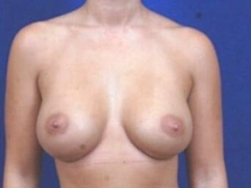 Breast Augmentation by Dr. Wilder Before & After Gallery - Patient 55455552 - Image 2