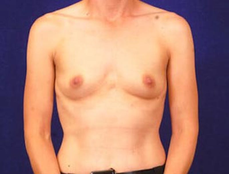 Breast Augmentation by Dr. Wilder Gallery - Patient 55455566 - Image 1
