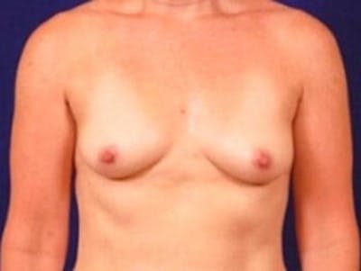 Breast Augmentation by Dr. Wilder Before & After Gallery - Patient 55455570 - Image 1